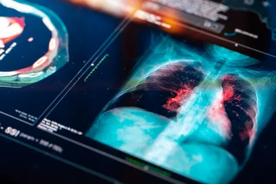 lung cancer imaging