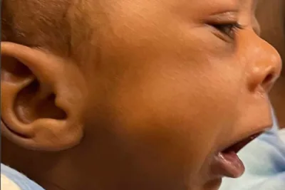NaKyng Before mandible distraction surgery