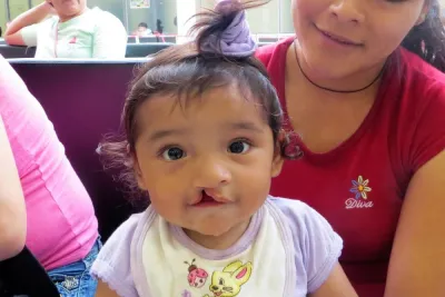 a baby with a cleft lip