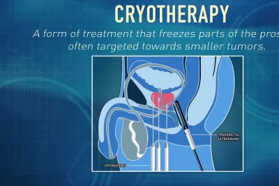 What is Cryotherapy? | Global Robotics Institute | AdventHealth