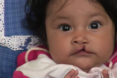A Smile Found • SHARES International Surgical Mission