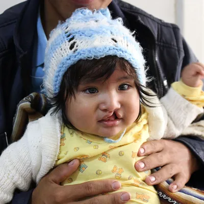 a young boy with a cleft lip