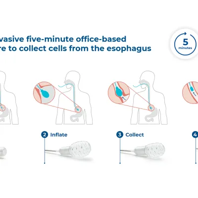 EsoGuard™ Infographic