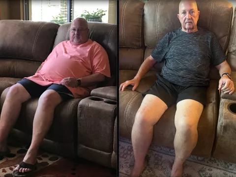 Jim’s Bariatric Surgery Journey