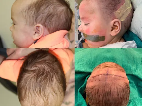 Craniofacial peds patient