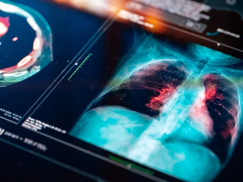 lung cancer imaging