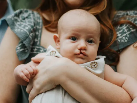Henry before cleft lip surgery