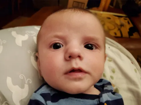 Mikey after Craniosynostosis Treatment