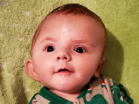 Mikey before Craniosynostosis Treatment