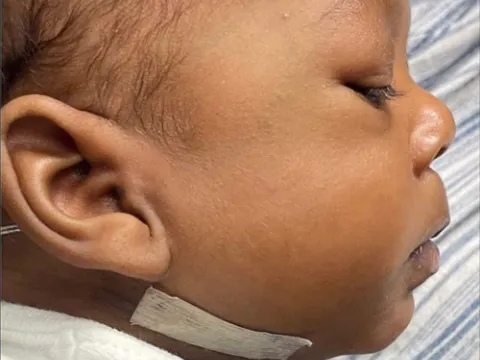 NaKyng after mandible distraction surgery