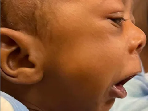 NaKyng Before mandible distraction surgery