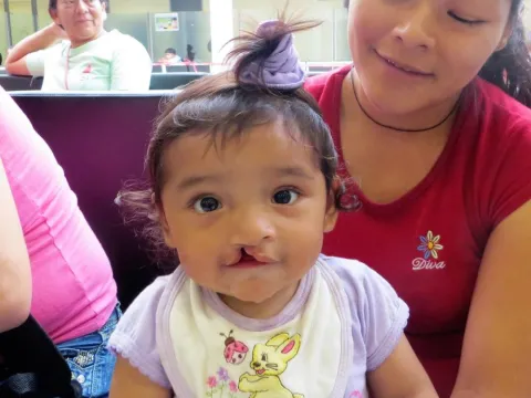 a baby with a cleft lip
