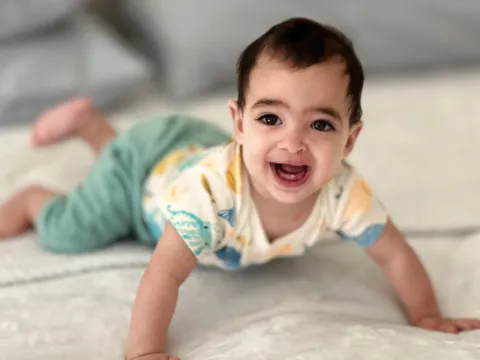 Piero after cleft surgery