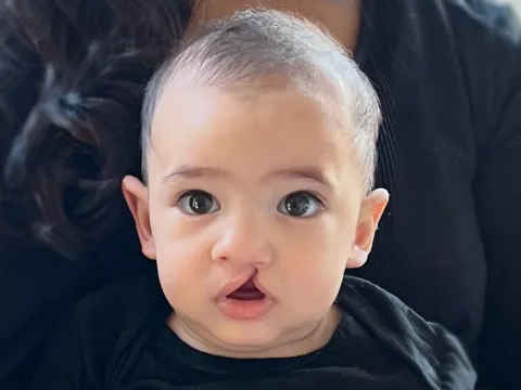 Piero Before cleft surgery