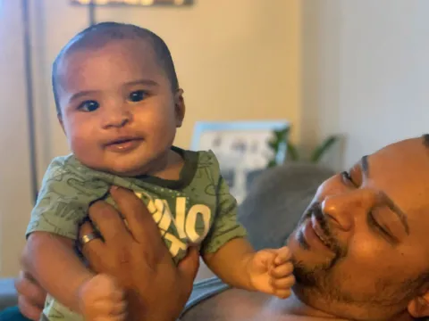 Romeo after cleft lip surgery