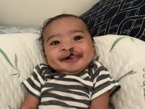 Romeo Before Cleft Lip Surgery