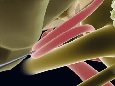 Endoscopic Microvascular Decompression - Minimally Invasive Brain Surgery