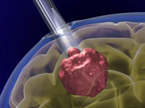 Brain Port Surgery - Minimally Invasive Brain Surgery
