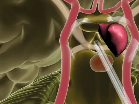 Endoscopic Endonasal Skull Base Surgery - Minimally Invasive Brain Surgery