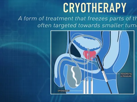 What is Cryotherapy? | Global Robotics Institute | AdventHealth
