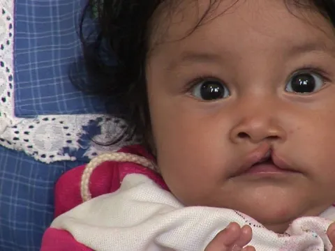 A Smile Found • SHARES International Surgical Mission