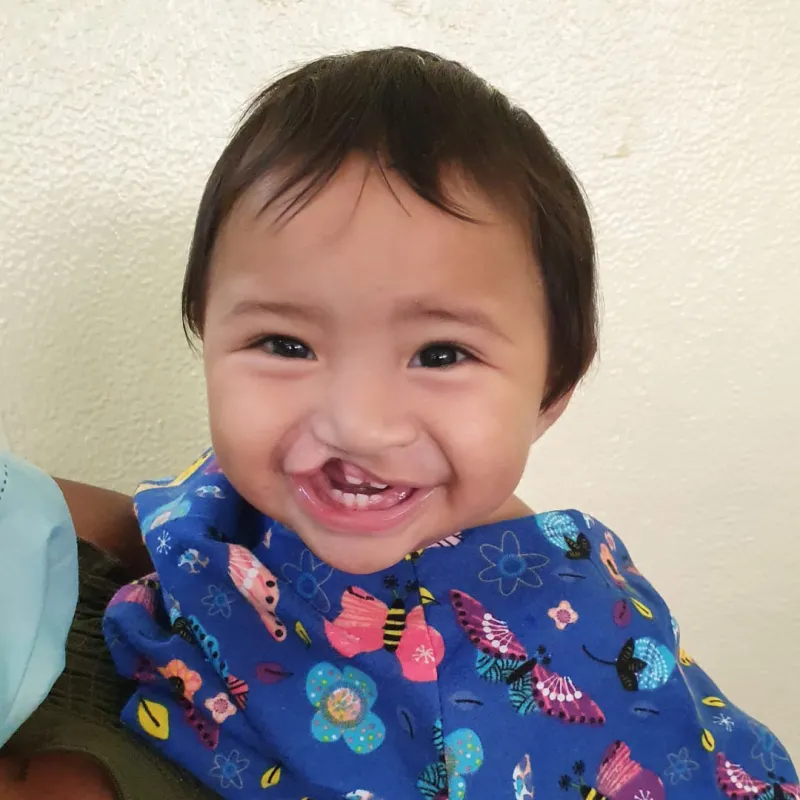 a baby with a cleft lip