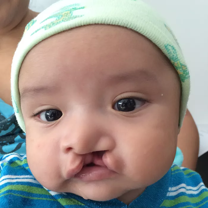 a baby with a cleft lip