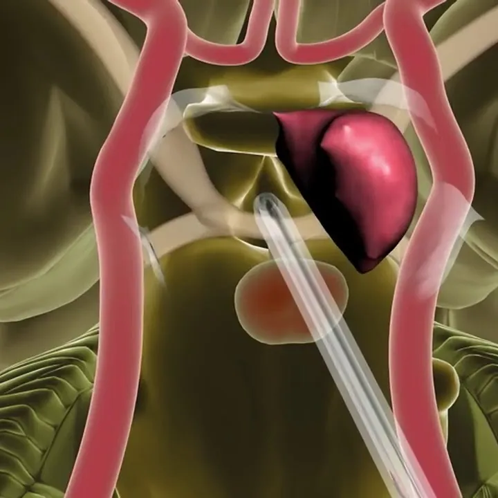 Endoscopic Endonasal Skull Base Surgery - Minimally Invasive Brain Surgery