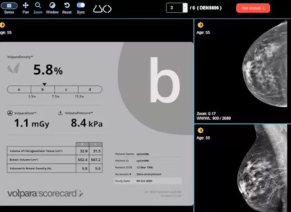 Volpara Scorecard AI risk assessment