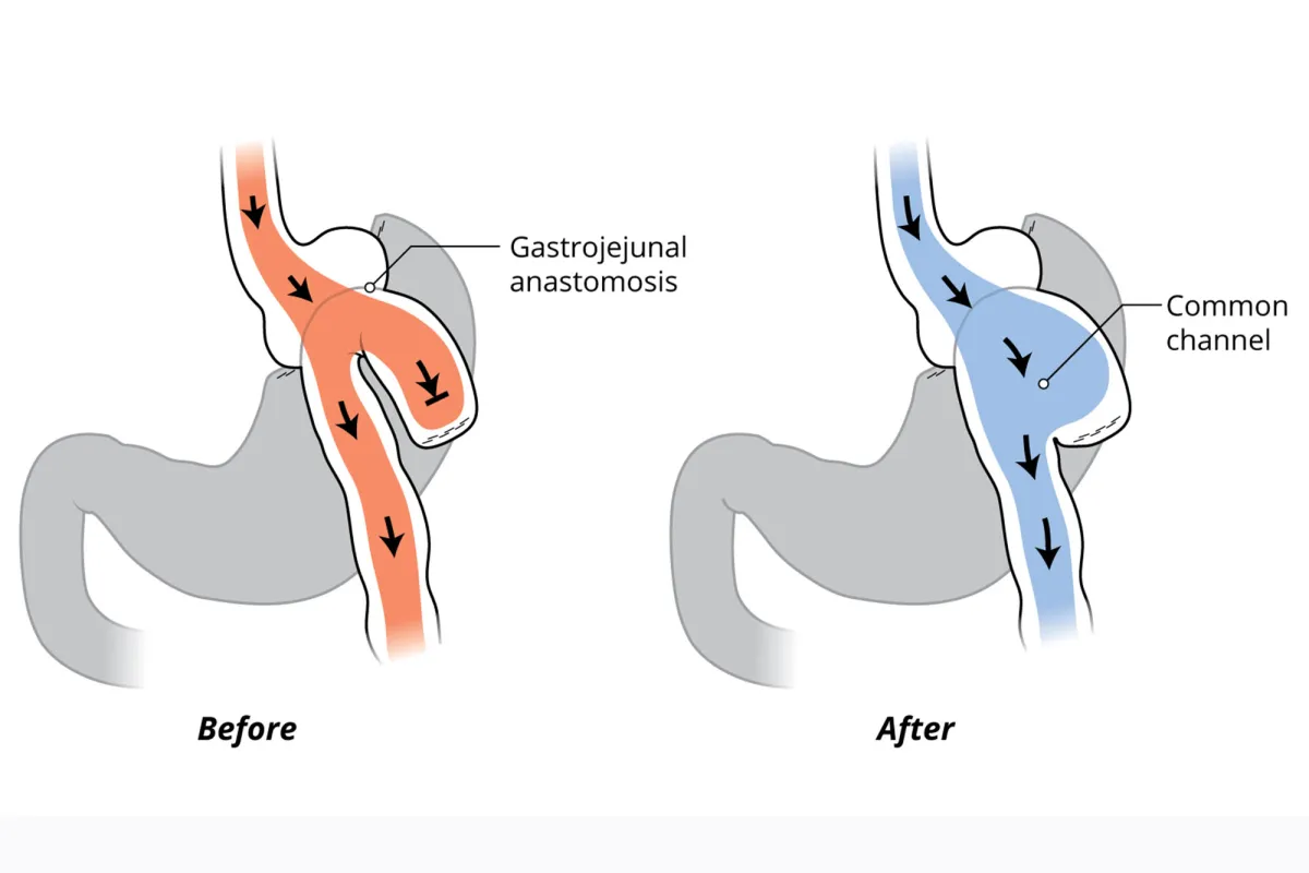 Before and after sketches of Candy Cane procedure