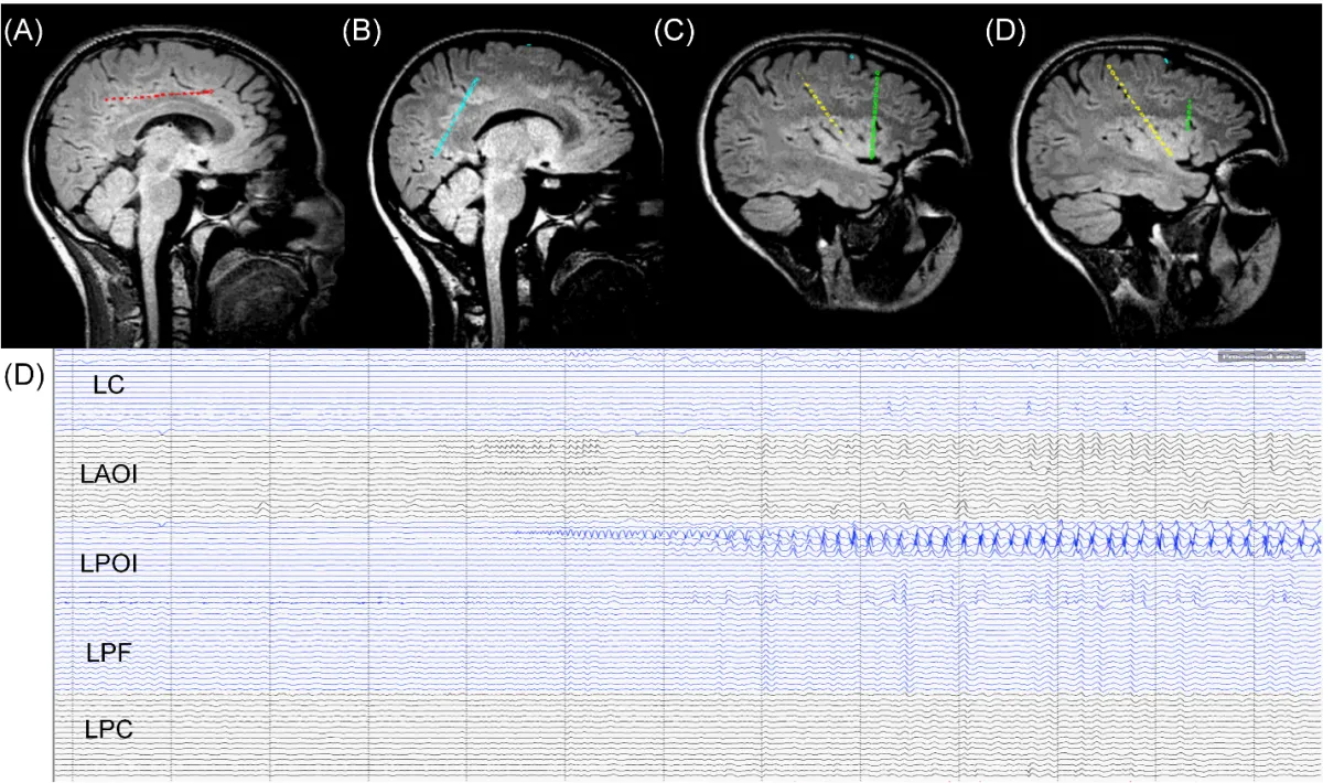 Epilepsy
