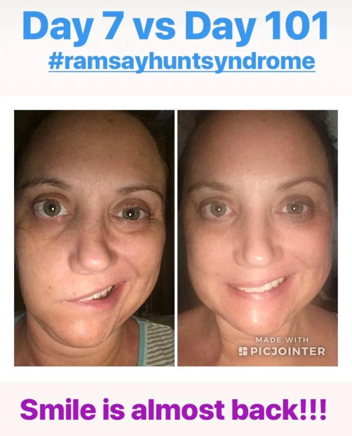 Ramsay Hunt Syndrome