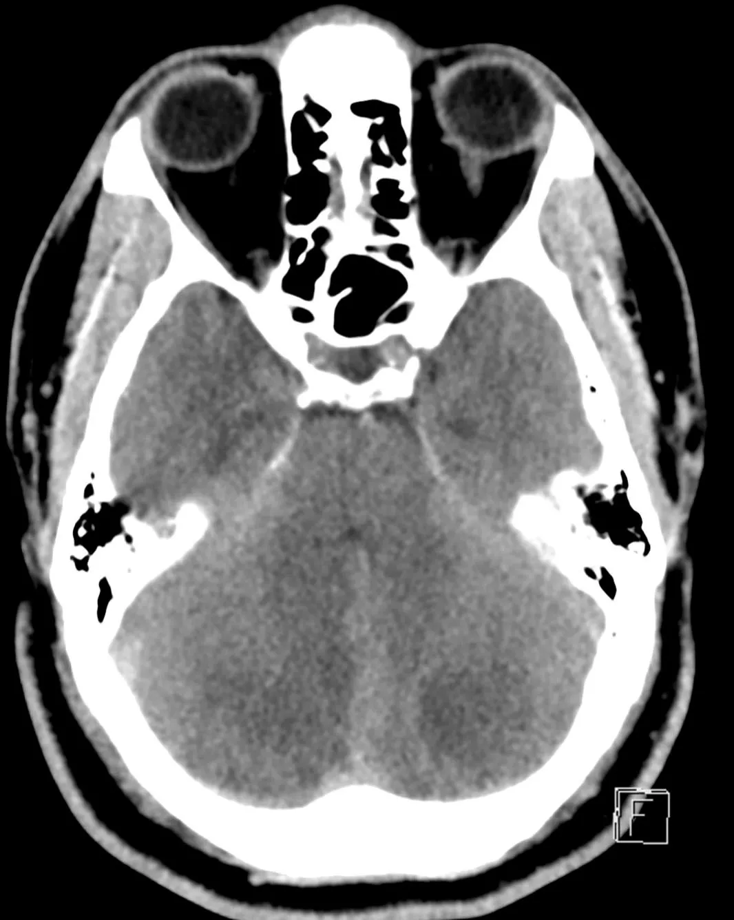 Dr. Morgan - Complex Stroke Case Study