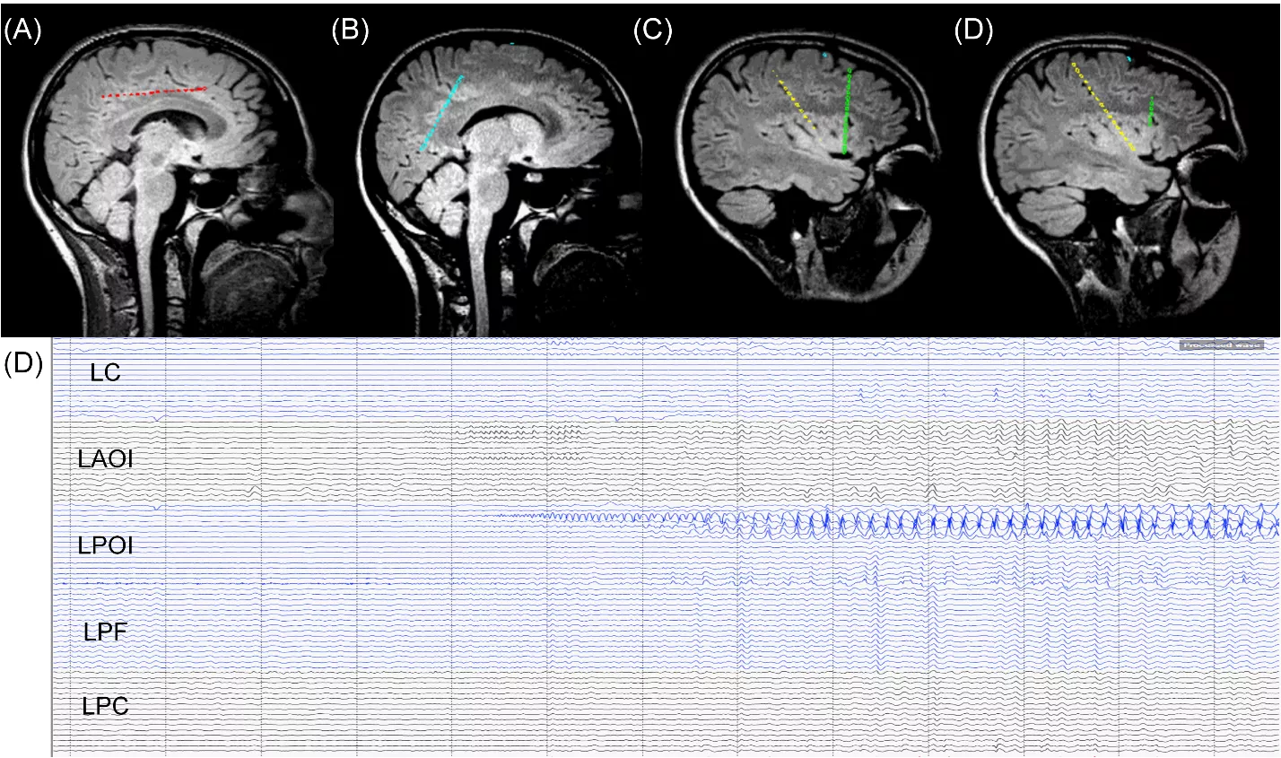 Epilepsy 